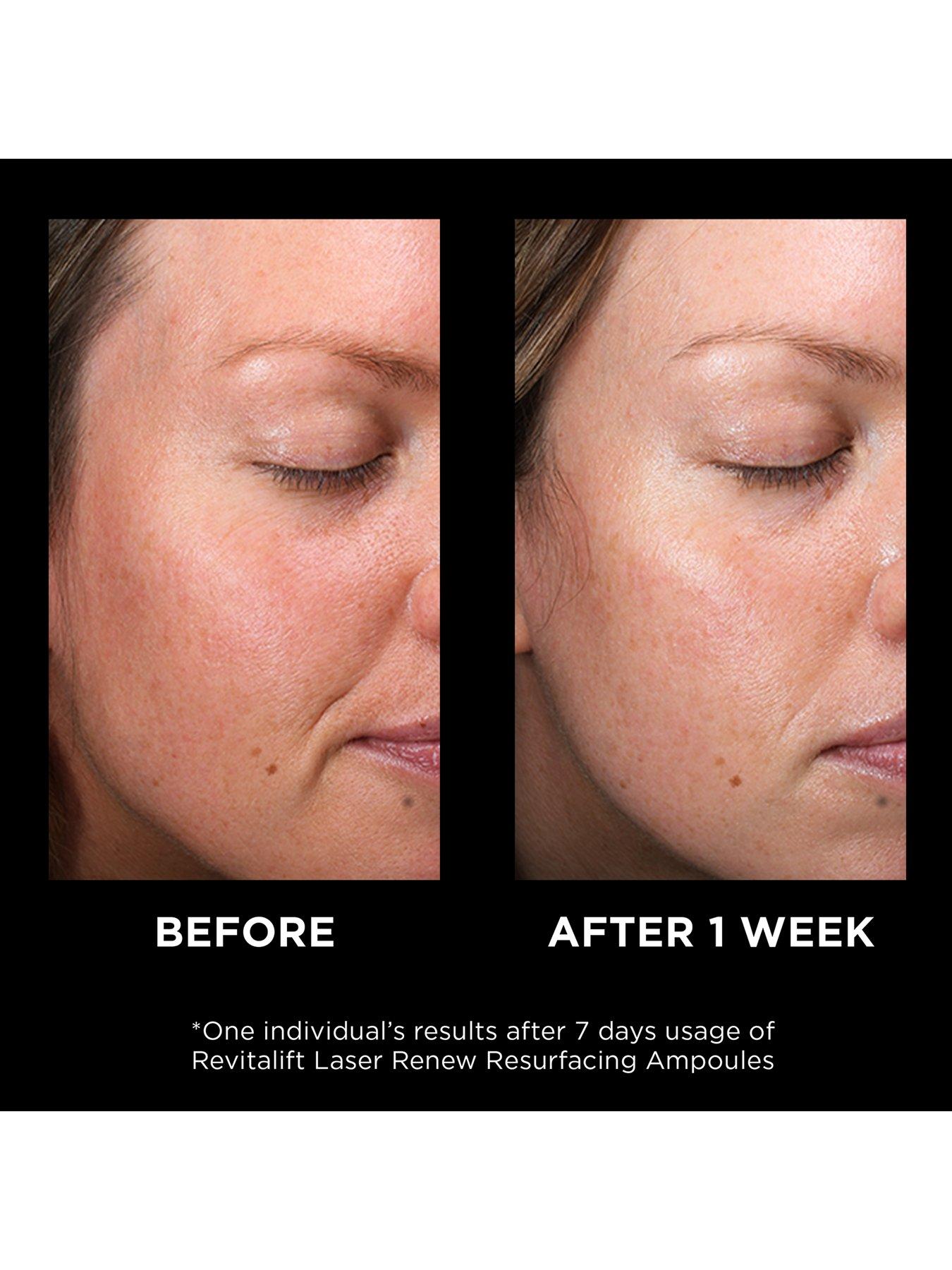revitalift before and after