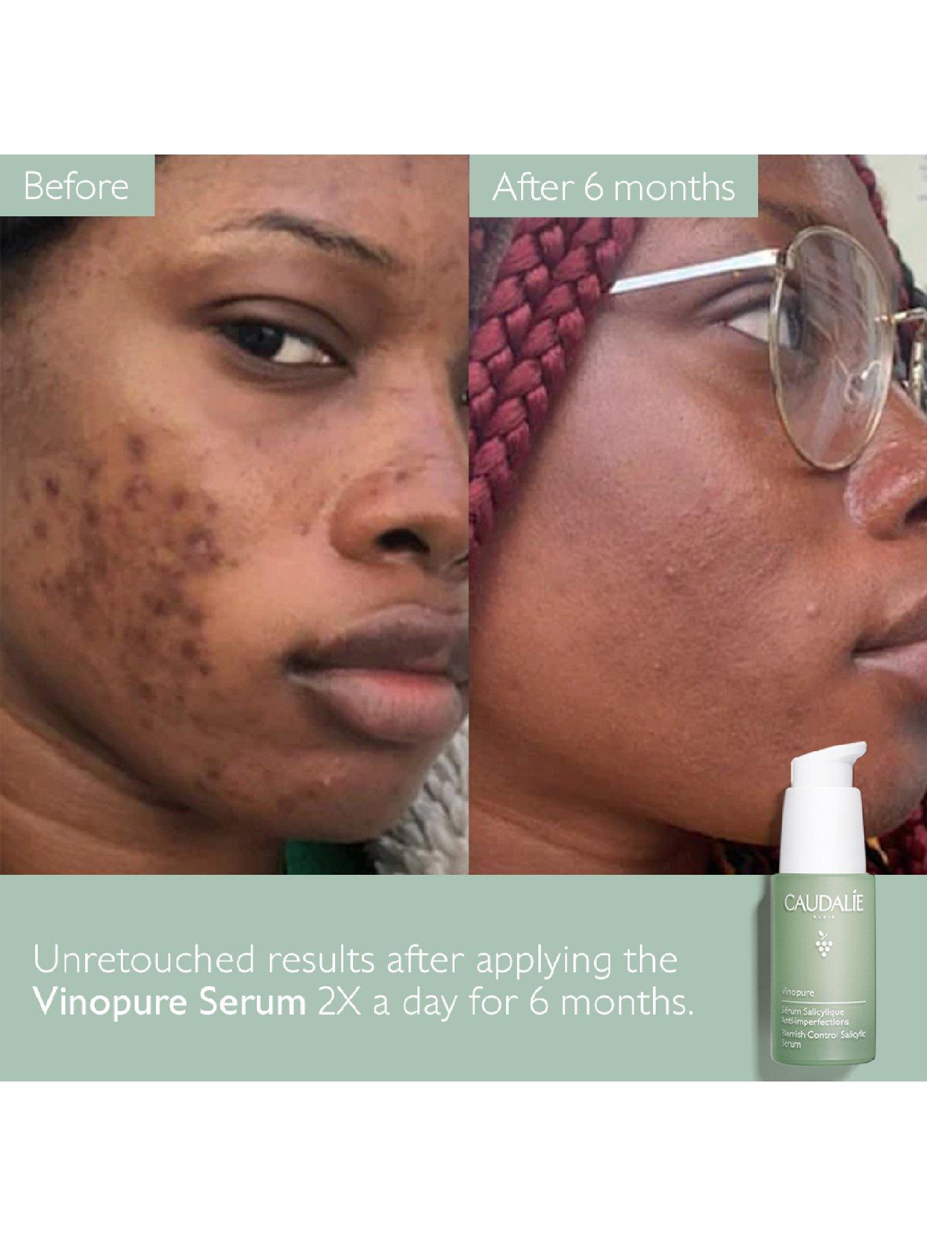 Image 3 of 7 of Caudalie Vinopure Blemish Control Salicylic Serum