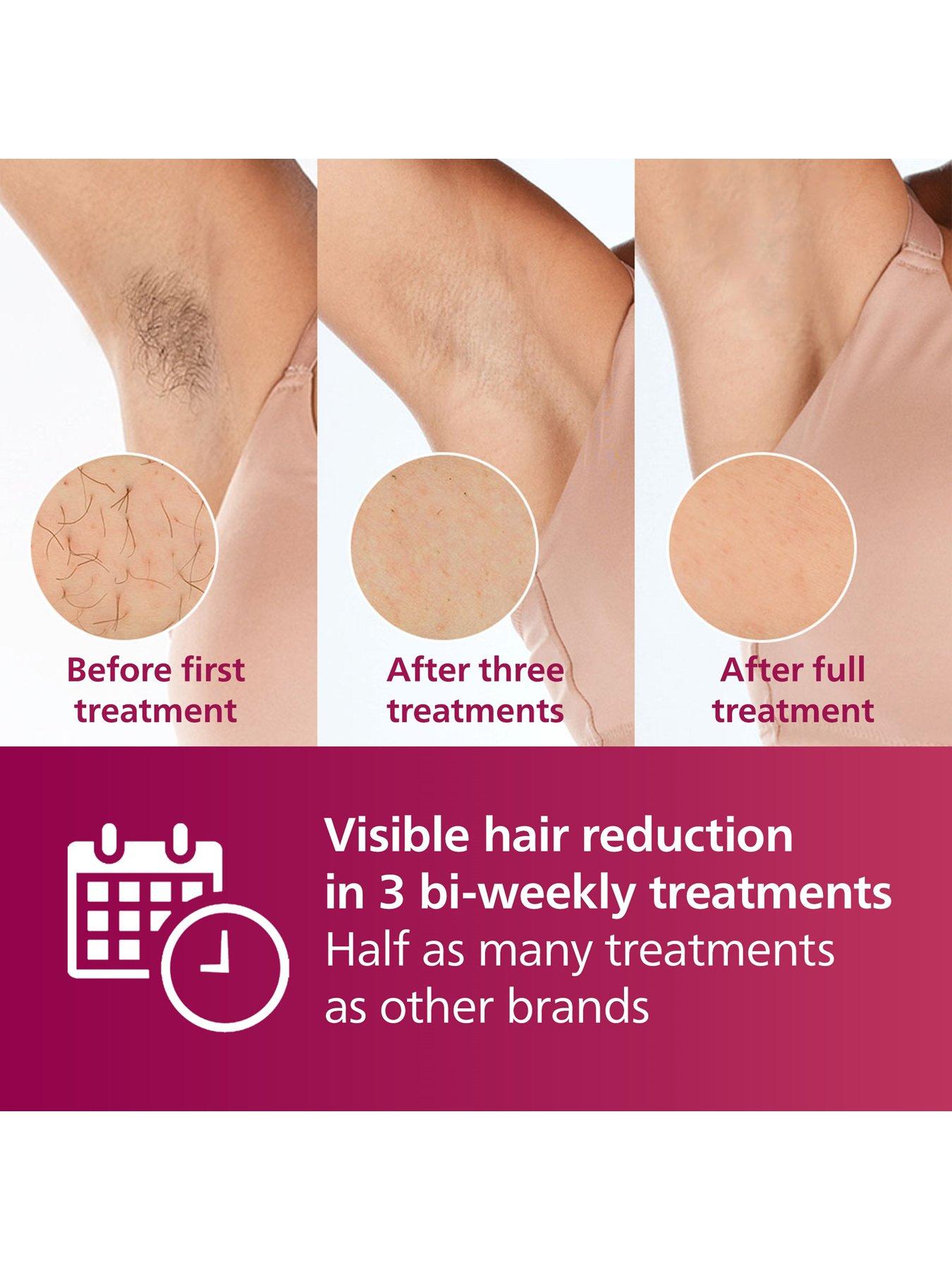 Image 3 of 8 of Philips Lumea 7000 Series, IPL Hair Removal Device, with Satin Compact Pen Trimmer, 3 Attachments for Body, Face and Bikini, BRI923/00