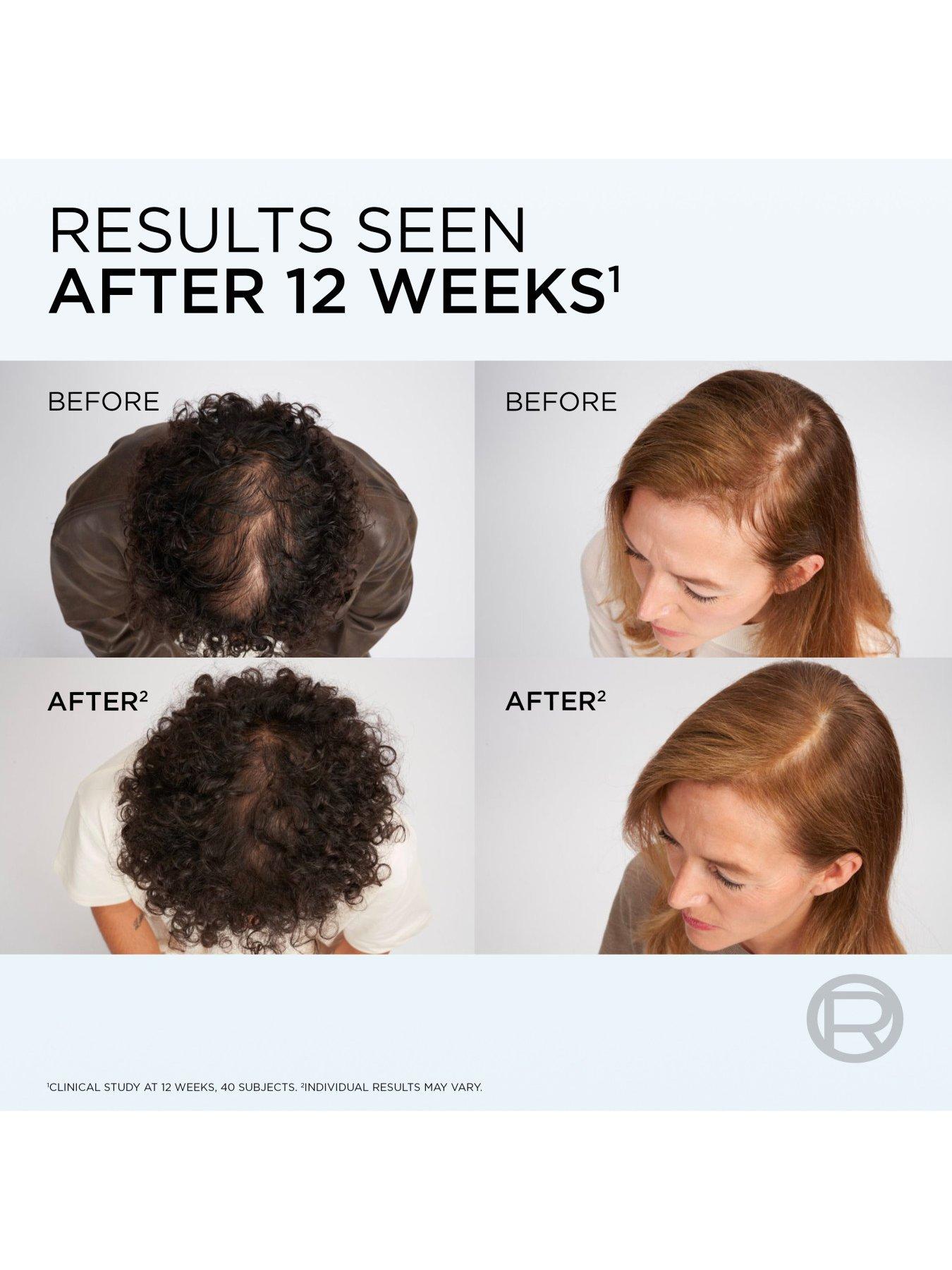 Image 5 of 6 of L'Oreal Paris Elvive Growth Booster Scalp Serum, Anti Hair Loss Scalp Treatment - 102ml